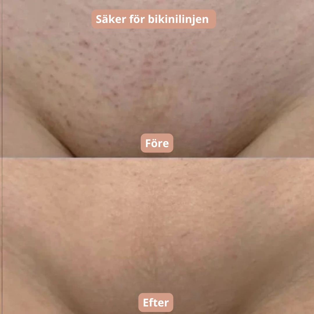 Pureshave Ultra - Glem alt om røde pletter og irriteret hud!